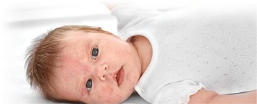 babies_at_risk_of_allergy_ar